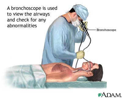 Bronchoscopy