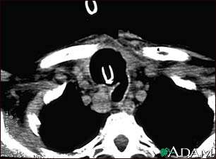 Thyroid cancer - CT scan