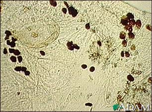 Scabies mite, photomicrograph of the stool