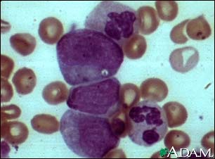 Chronic myelocytic leukemia