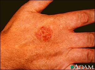 Bowen's disease on the hand