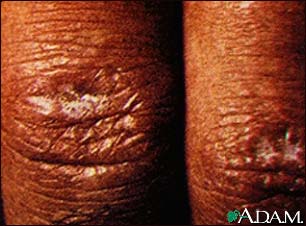 Dermatomyositis, Gottron's papule