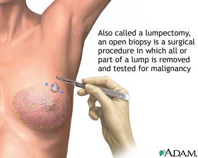 Open biopsy of the breast