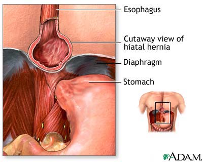 Hiatal hernia