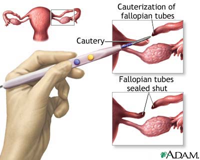 Tubal ligation