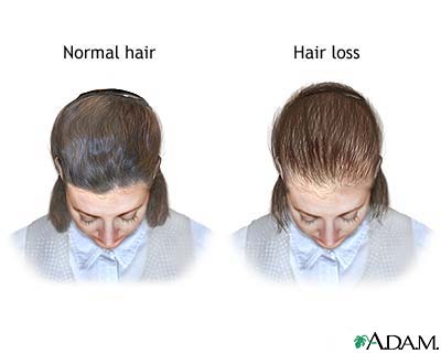 Female-pattern baldness