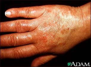 Vasculitis, urticarial on the hand