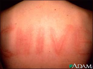 Dermatographism on the back