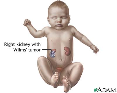 Wilms tumor