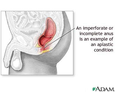 Aplastic condition