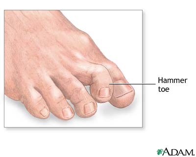 Hammer toe