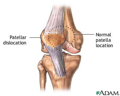 Patellar dislocation