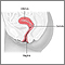 Cervical dysplasia - series