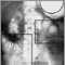 Ileus - X-ray of distended bowel and stomach