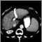 Liver cirrhosis, CT scan