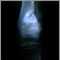 Osteogenic sarcoma - X-ray