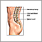 Spinal fusion  - series