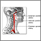 Carotid artery surgery - series