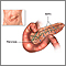 Pancreas transplant - series