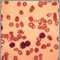 Chronic lymphocytic leukemia - microscopic view