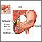 Endoscopic retrograde cholangio pancreatography (ERCP) - series