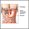 Gastroesophageal reflux - series