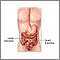 Intestinal obstruction repair - series