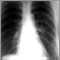 Coccidioidomycosis - chest X-ray