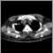 Pulmonary nodule, solitary - CT scan