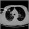 Lung mass, right upper lobe - CT scan