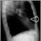 Lung nodule, right middle lobe - chest X-ray