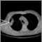 Lung mass, right lung - CT scan