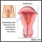 Endometritis