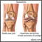 Osteoarthritis