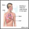 Disseminated coccidioidomycosis