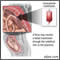 Intrauterine transfusion