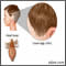 Head lice