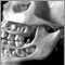 Teeth, adult - in the skull