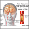 Atherosclerosis of internal carotid artery