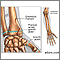 Fractures across a growth plate