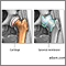 Osteoarthritis vs. rheumatoid arthritis