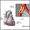 Atherosclerosis