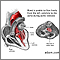 Aortic stenosis