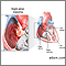 Right atrial myxoma