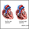 Tricuspid Regurgitation