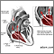 Tricuspid Regurgitation