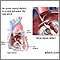 Atrial septal defect