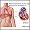 Dilated cardiomyopathy