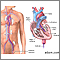 Left heart catheterization