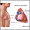 Constrictive pericarditis